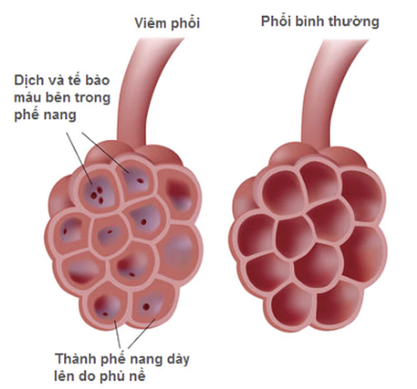Viêm phổi thuộc chứng phế ung.